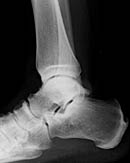 SG-Arthrose